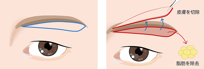 上眼瞼リフト（眉下切開）