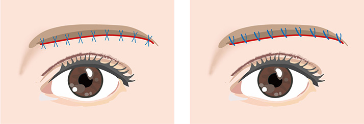 上眼瞼リフト（眉下切開）