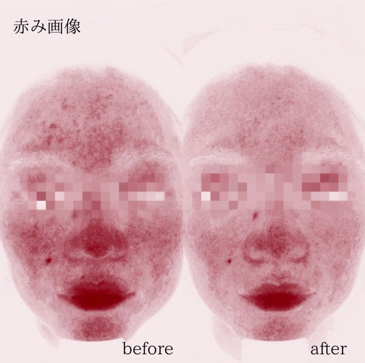 【症例写真のご紹介】肌育注射「プルリアル デンシファイ」