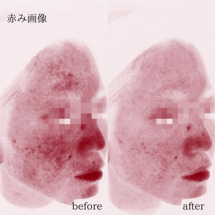 【症例写真のご紹介】肌育注射「プルリアル デンシファイ」