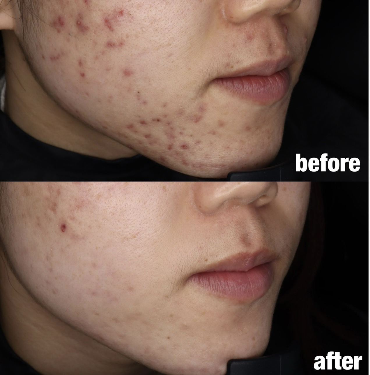 ニキビ・ニキビ痕治療