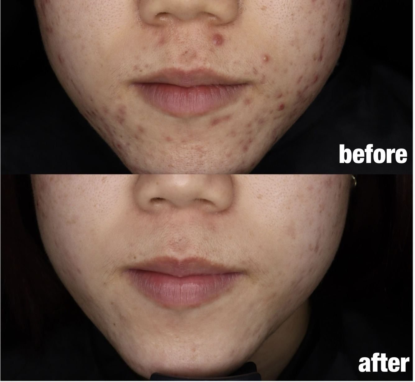 ニキビ・ニキビ痕治療