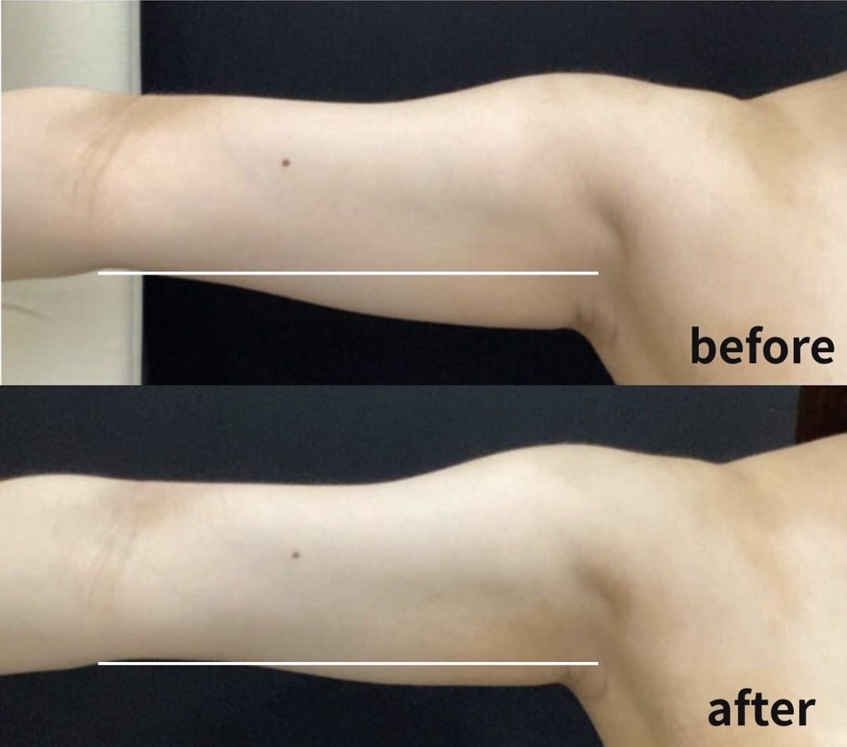 クールスカルプティング　エリート　症例