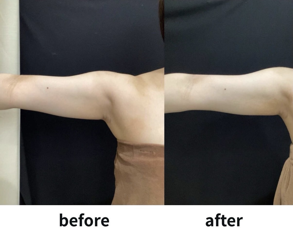 クールスカルプティング：二の腕