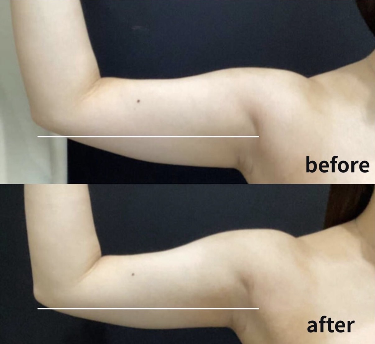 クールスカルプティング：二の腕