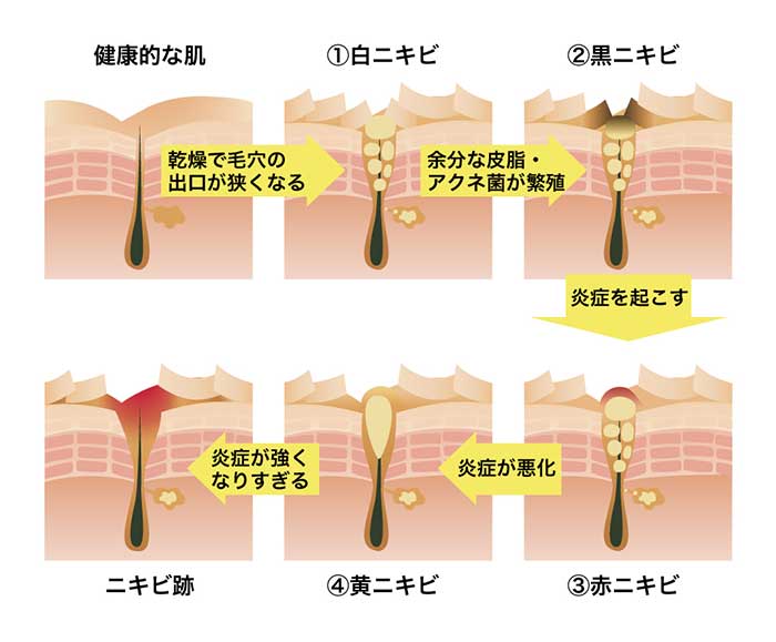 にきび・にきび痕治療 | メンズ神戸ゆりクリニック