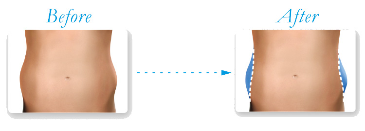 クールスカルプティング