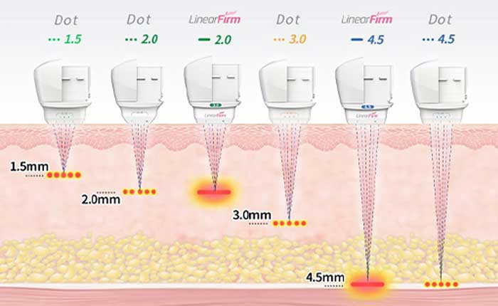 医療用ハイフ　ウルトラセルQプラスカートリッジ
