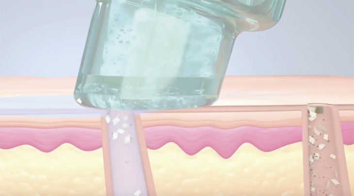 ハイドラフェイシャル