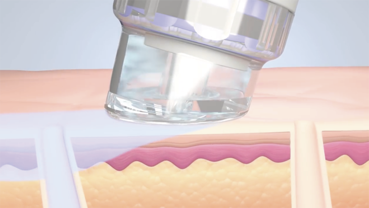 ハイドラフェイシャル