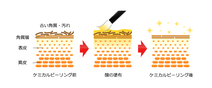 ケミカルピーリング