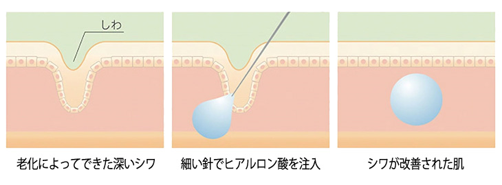 ヒアルロン酸注入とは
