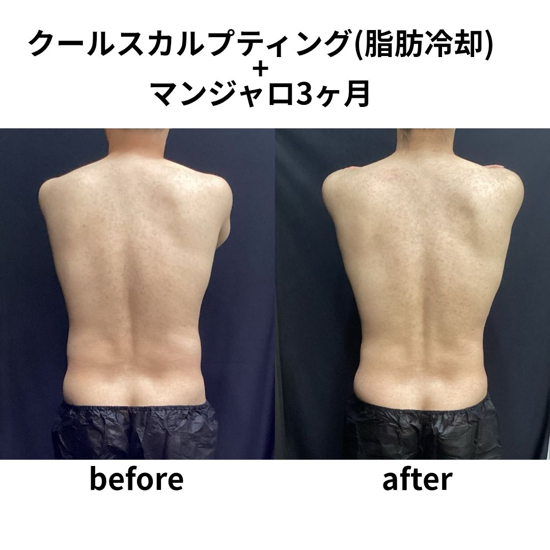 クールスカルプティング　エリート　症例