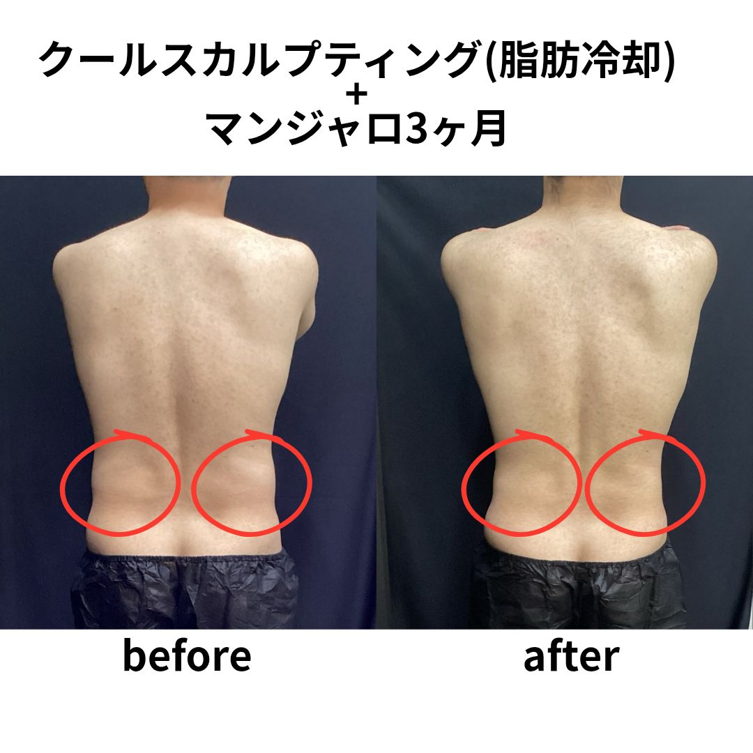 クールスカルプティング　エリート　症例