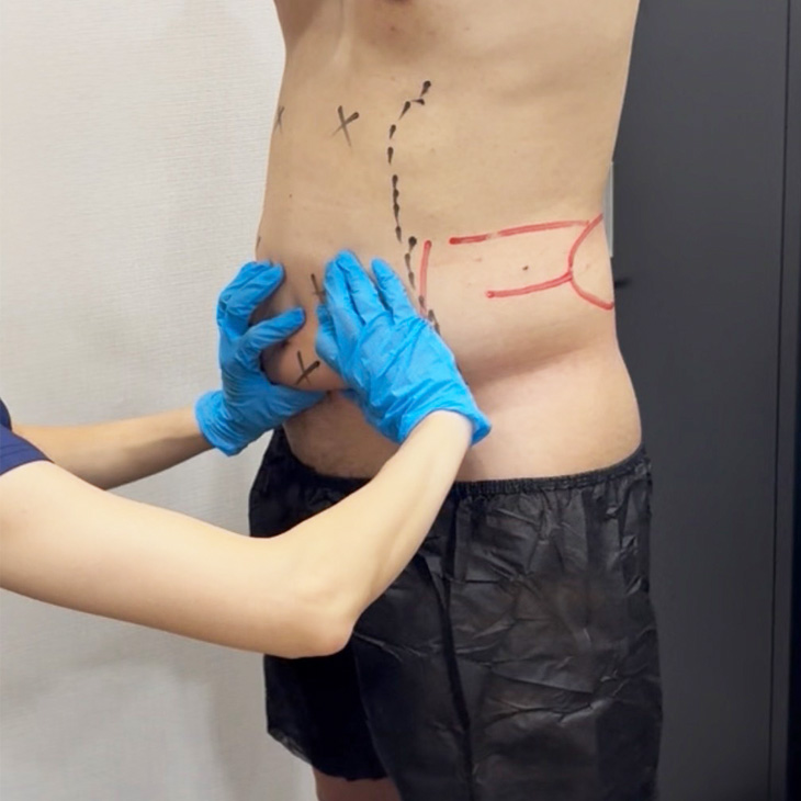 クールスカルプティング® アセスメント