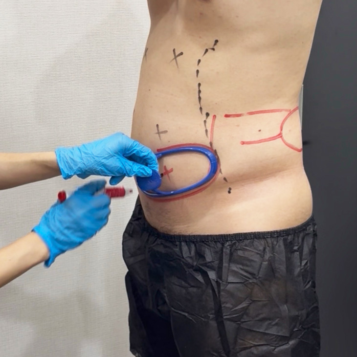 クールスカルプティング® アセスメント