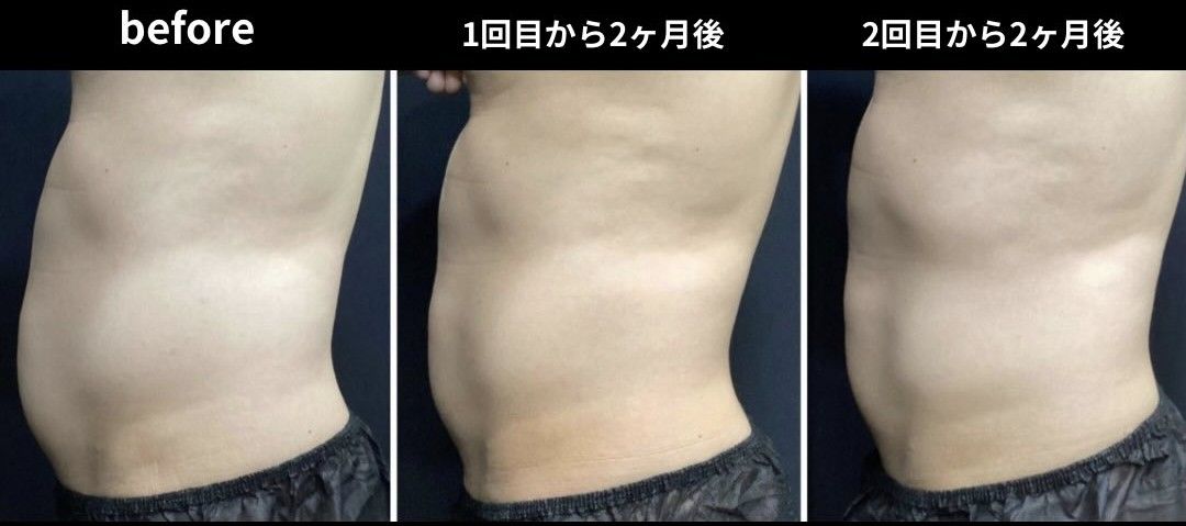 クルスカ施術前後