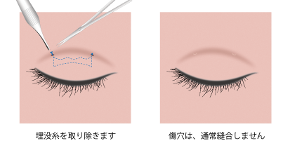 他院糸抜き 埋没糸抜去術 二重まぶた 目もと 神戸ゆりクリニック
